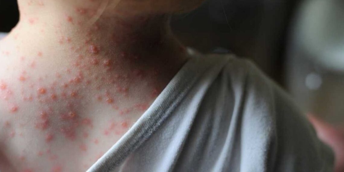 viruela del mono en humanos