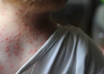 viruela del mono en humanos