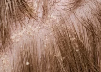 psoriasis en el cuero cabelludo