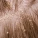 psoriasis en el cuero cabelludo