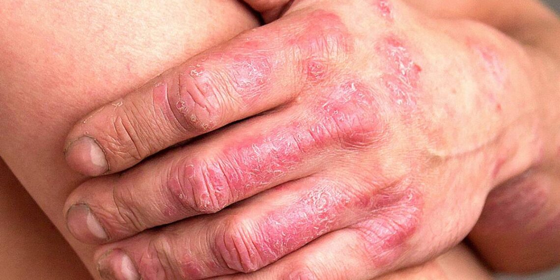 psoriasis