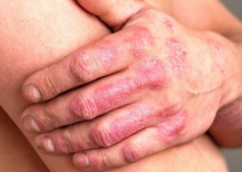 psoriasis