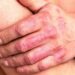 psoriasis