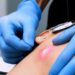 Endolift Facial
