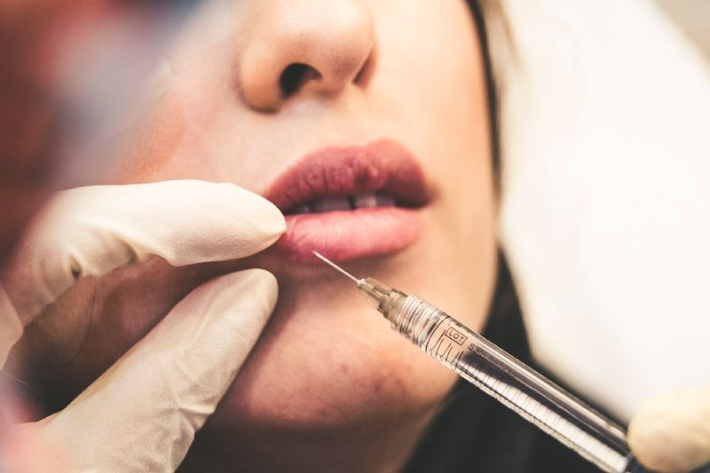 La aplicación de ácido hialurónico en los labios, ¿una solución eficaz?