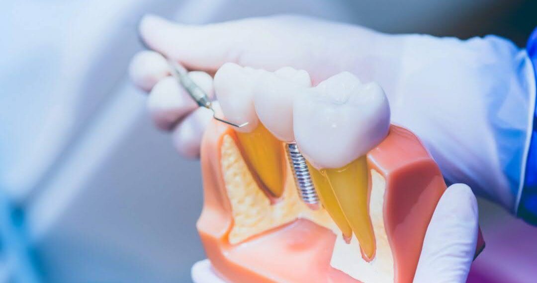 Transforma tu sonrisa con prótesis e implantes dentales en Lima