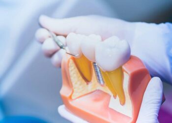 Transforma tu sonrisa con prótesis e implantes dentales en Lima