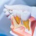 Transforma tu sonrisa con prótesis e implantes dentales en Lima